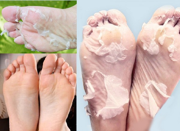 굳은 살과 옥수수 크림