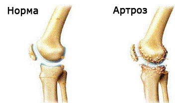 무릎 관절의 민간 arthrosis 치료