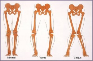 무릎 관절의 민간 arthrosis 치료